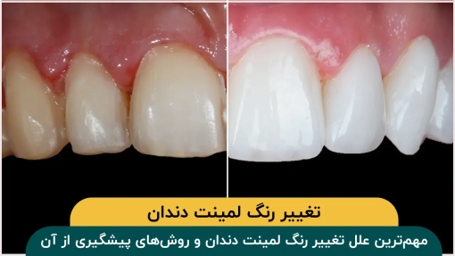 تغییر-رنگ-لمینت-دندان